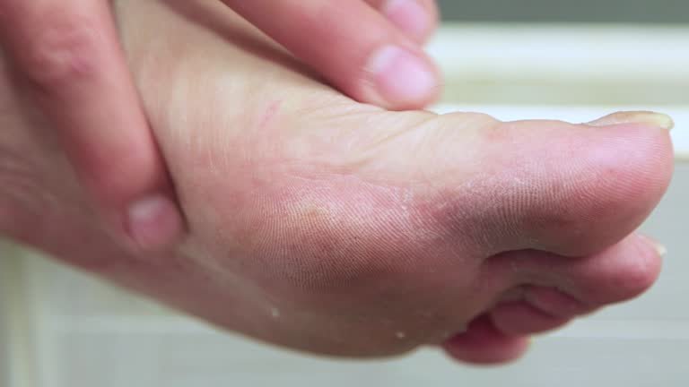  İnsan Ayağında Neden Mantar Çıkar ?